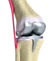 Complex Knee Replacement