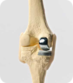 Knee Replacement surgeries
